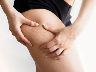Ocho de cada diez mujeres sufre celulitis, ¿realmente se puede combatir?