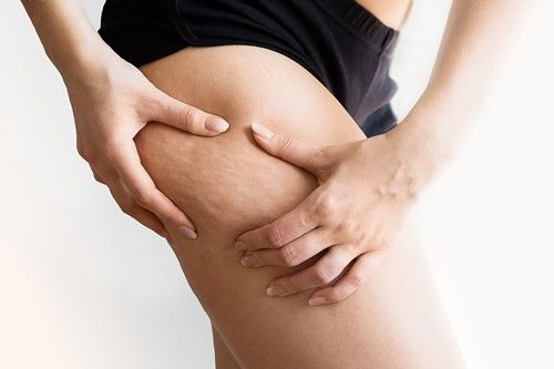 Ocho de cada diez mujeres sufre celulitis, ¿realmente se puede combatir?